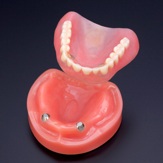 磁石の力で脱落を防ぐ「磁性アタッチメント義歯」
